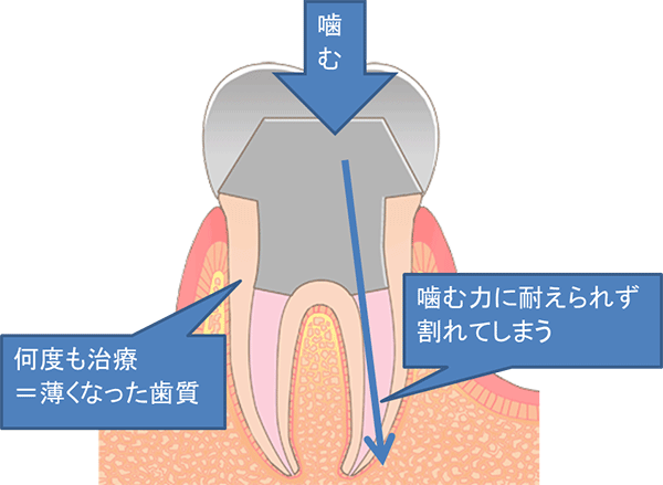 歯の割れの構造
