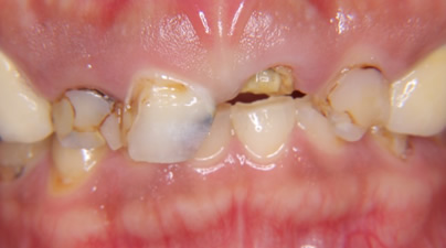 歯は硬い組織ですが力がかかりすぎると摩耗してきたり、かけたりすることがあります。