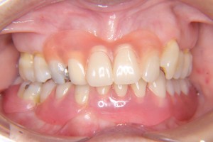 denture-case01-af