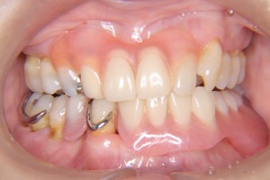 denture-case01-bf