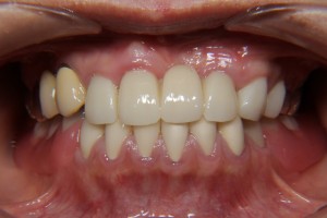 denture-case02-af01