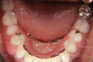 denture-case02-af02