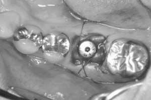 implant-case02-af2