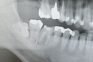 implant-case02-bf1