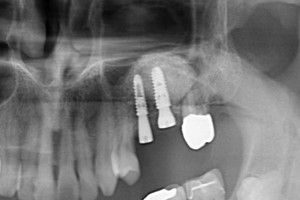 implant-case03-af2