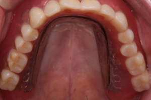 implant-case05_2